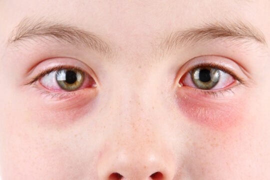 conjunctivitis (pink eye)